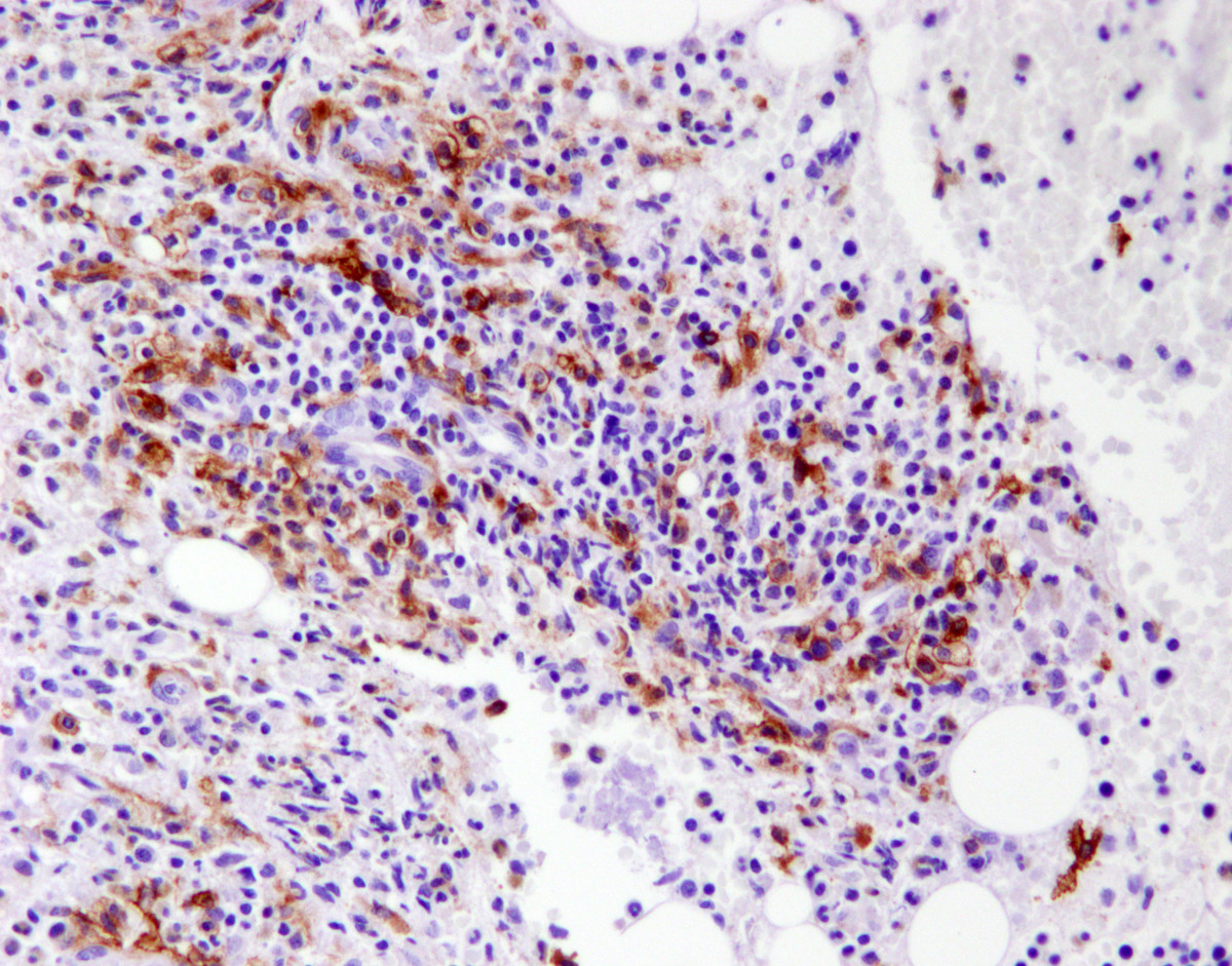 Image 16, CD117 on bone marrow biopsy